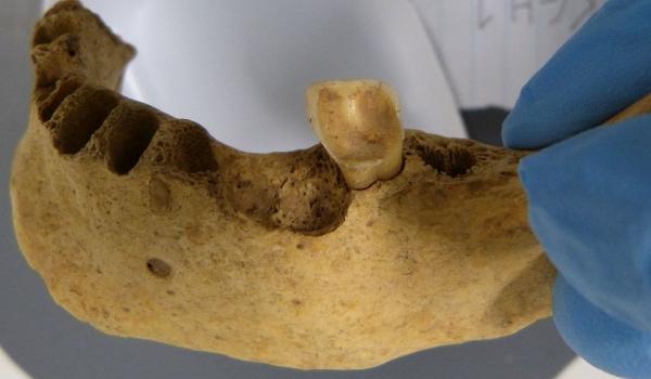 Por que nossos ancestrais não tinham cáries? Novo estudo ajuda a explicar